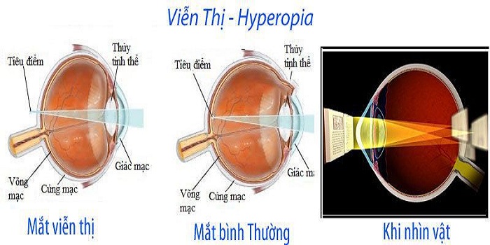 Viễn Thị Là Gì 6 Phương Pháp Điều Trị Viễn Thị Phổ Biến Nhất 